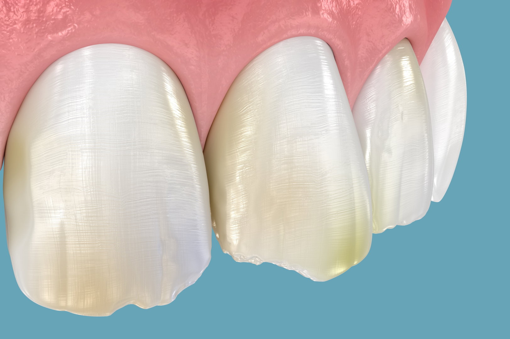 Broken Tooth Treatment