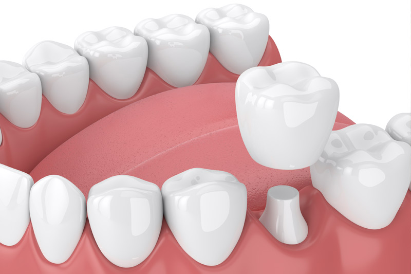 Dental Crowns in San Antonio