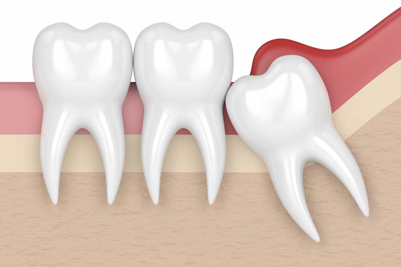 Wisdom Tooth Removal in San Antonio